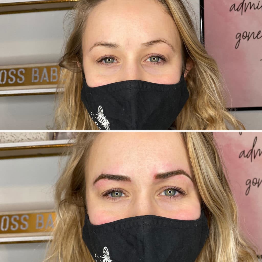 RF Microneedling Before After 4