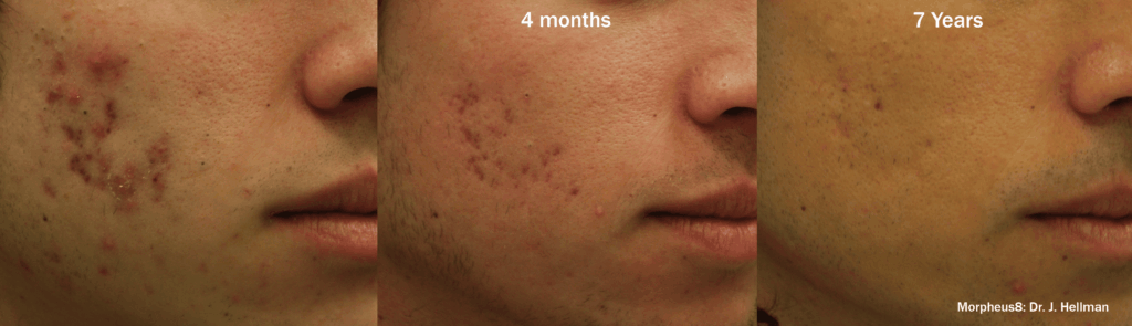 Treatments For Acne Scars And Modern Solutions That Actually Work Microneedling RF north ogden UT