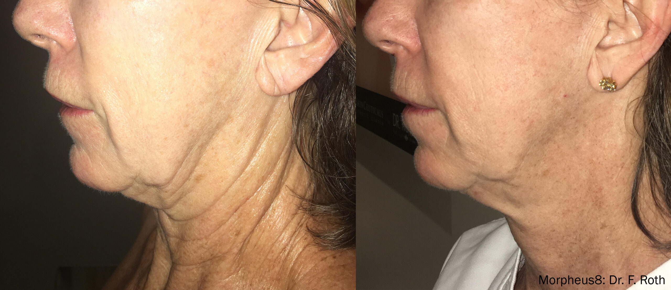 rf microneedling north ogden utah