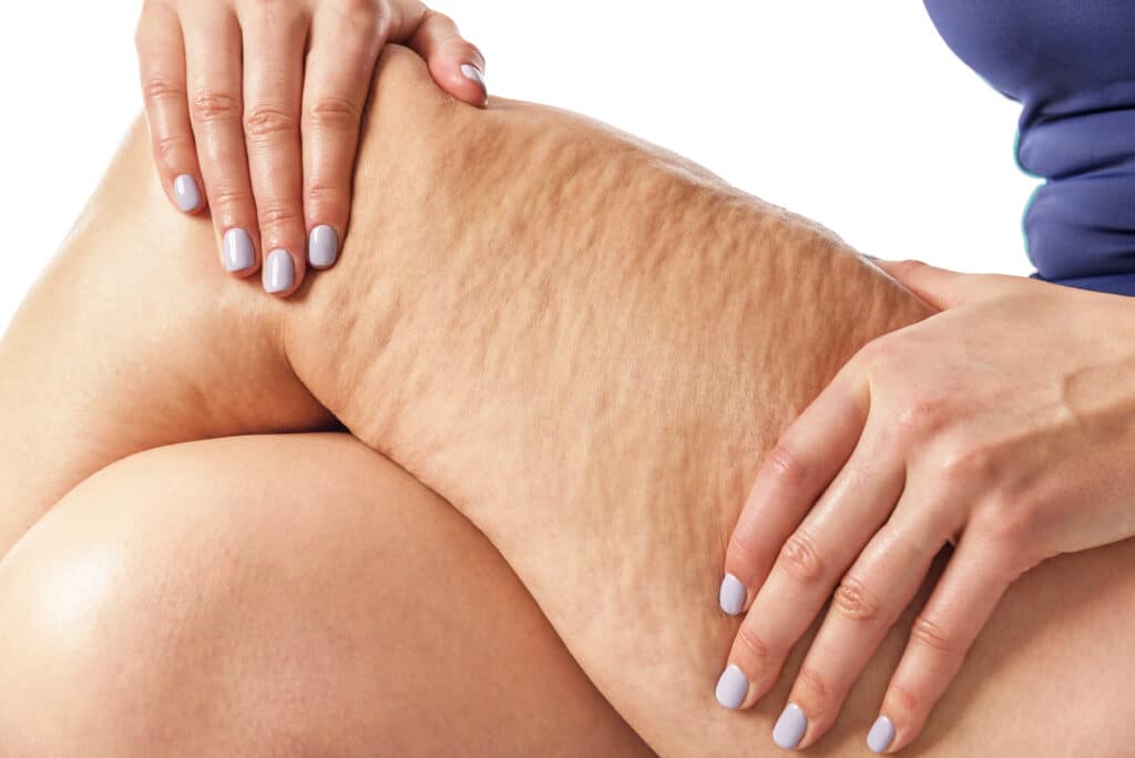 Cellulite myths