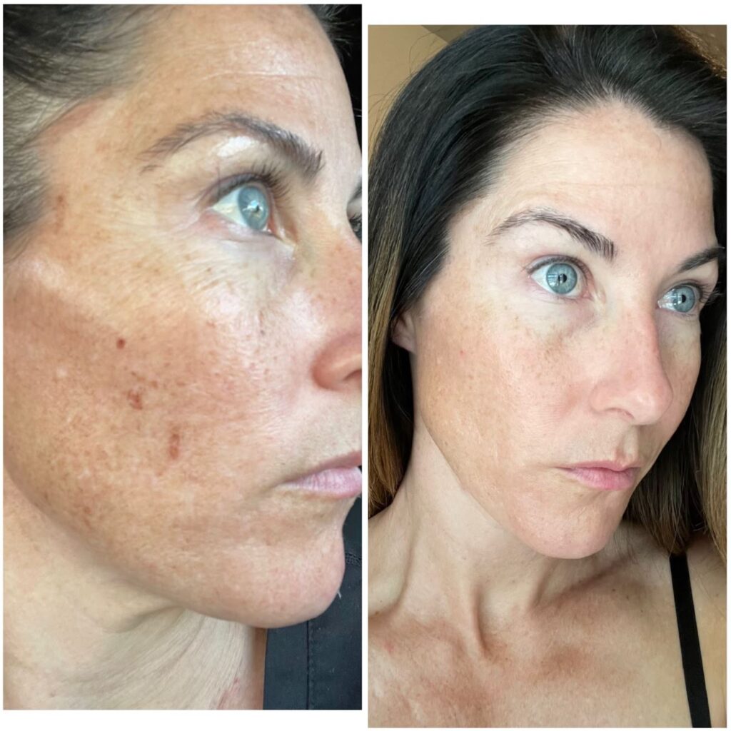 dermaplaning before and after picture