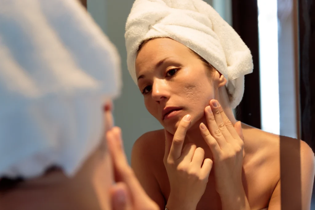 Treatments For Acne Scars And Modern Solutions That Actually Work Acne Scars